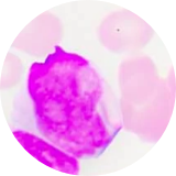Malignant cells in adult ALL
