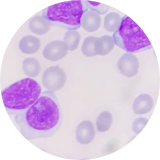 Malignant cells in CLL