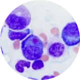 Malignant cells in multiple myeloma
